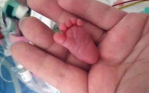 Emilia Grabarczyk was born via caesarean section at 25 weeks, and is believed to be the smallest ever baby to survive such an early delivery. Her foot was just an inch long...